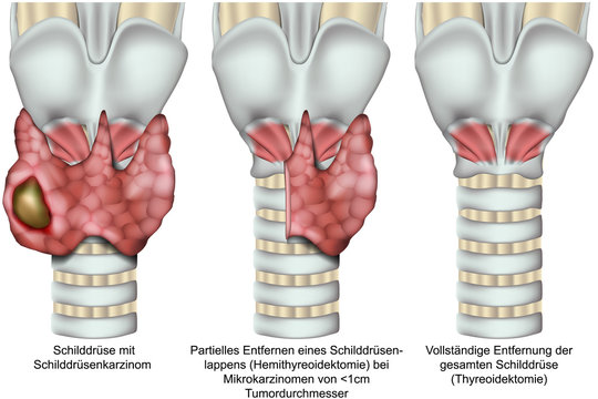 Thyreoidektomie, Entfernung der Schilddr&uuml;se bei einem Schilddr&uuml;senkarzinom, vektor illustration