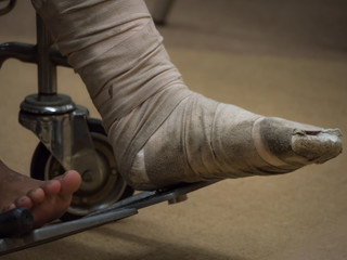 Selective focus at old and dirty splint that wrap on foot bone  fractured. Poor people sit on wheel chair while waiting doctor in public hospital.