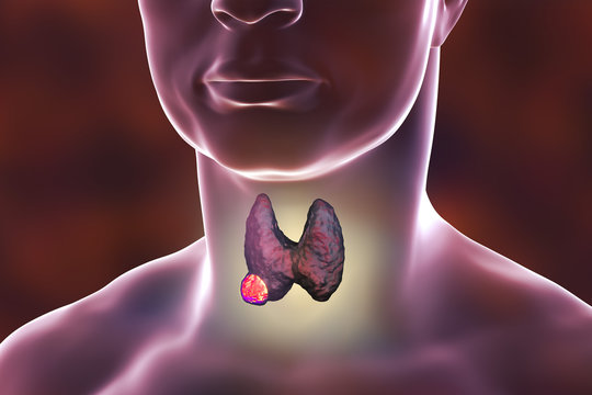 Thyroid cancer. 3D illustration showing thyroid gland with tumor inside human body