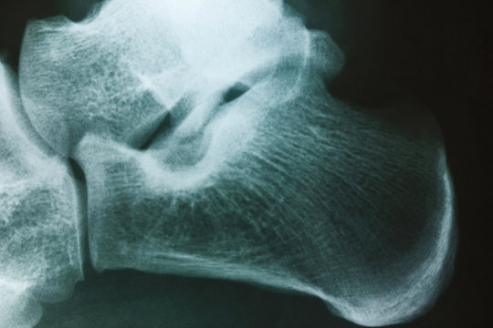 Male ankle x-ray background.