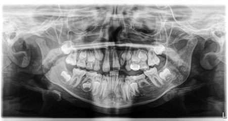 Wechselgebiss mit Nichtanlagen von Zähnen