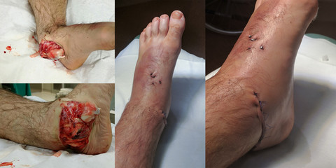 Open ankle sprain before and after surgery.