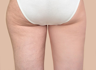 Buttocks of a woman before and after cellulite - obrazy, fototapety, plakaty