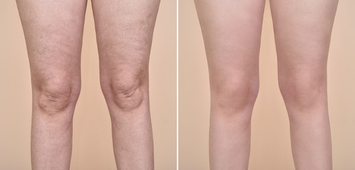 Legs of a woman before and after anti cellulite treatment - obrazy, fototapety, plakaty