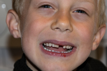 Young smiling boy without front tooth