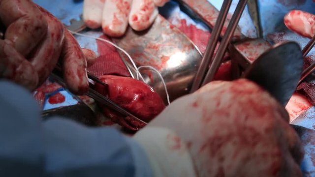 Uterus excision surgery close up