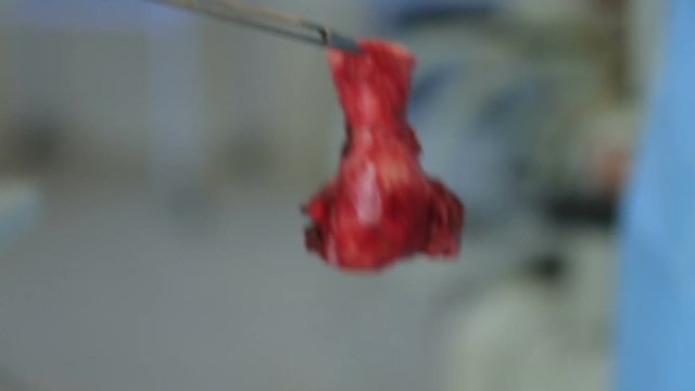 Uterus carved outside the body during the hysterectomy macro holden by surgical clamp and throwing away