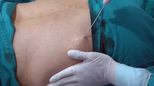 doctor doing tumescent before do liposuction