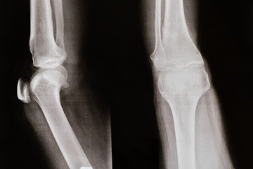 image of x-ray Osteoarthritis knee