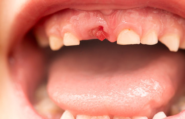 Fototapeta premium The mouth of a boy without a tooth
