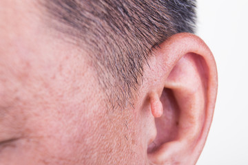 Obraz premium Human mutation with extra growth on ear