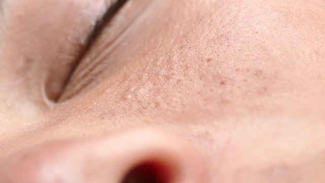 Squeezing pimple with comedone extractor tool
