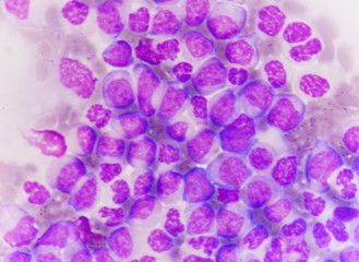 blast cells in Leukemia