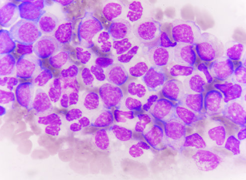 Blast Cells In Leukemia