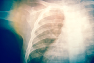 Close up bone  x-ray