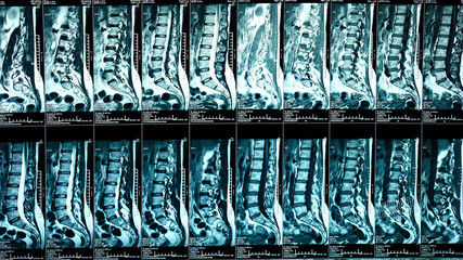 Magnetic resonance imaging of the human spine