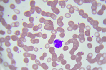 White blood cells in in blood smear, analyze by microscope
