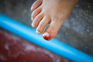 Naklejka premium Accident child's nail trauma , Fresh wound and blood from injured foot