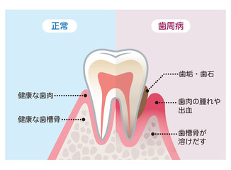 健康な歯と歯周病の歯　比較