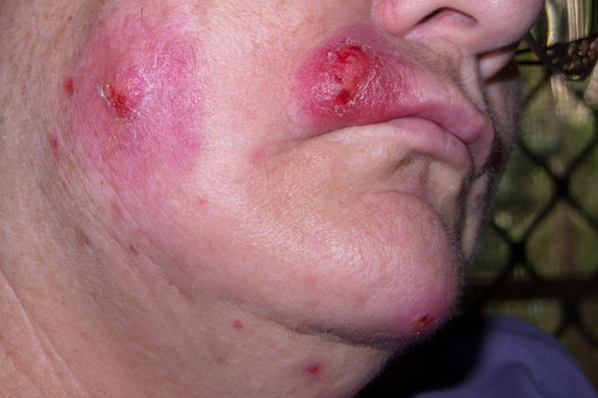 Mature woman with staph infection on face 8