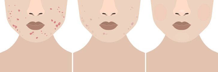 Woman before and after treatment