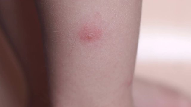 The tick bite on the leg of a small child, close-up. Allergy to insect bites.