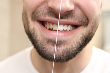 Result of teeth whitening. Smiling young man, closeup