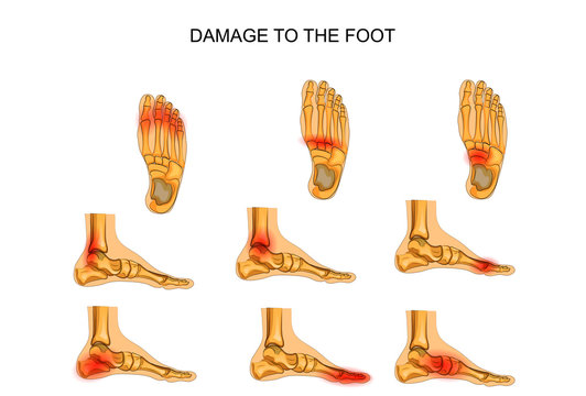 damage to the foot