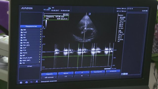 Medical ultrasound scan heart Echocardiogram shows  views of valsalva tests on beating heart

