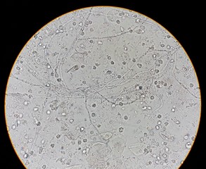 Abnormal result of urinalysis examination from microscopic method under 40X light microscope; show...