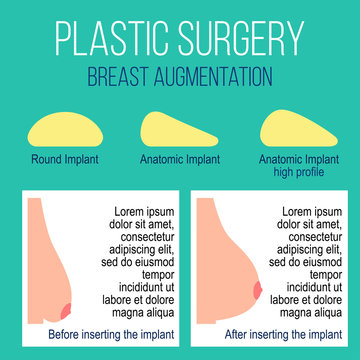 Plastic breast surgery Vector illustration Types of breast implants with description Female breast before and after plastic surgery Flat design