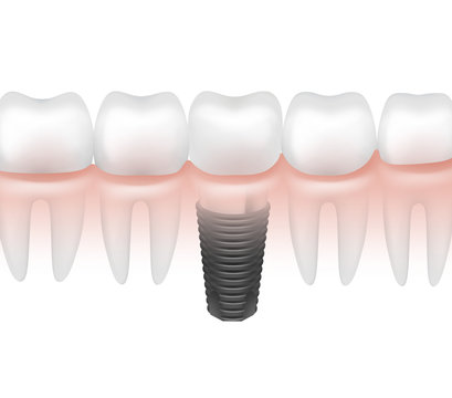 Metal tooth implant