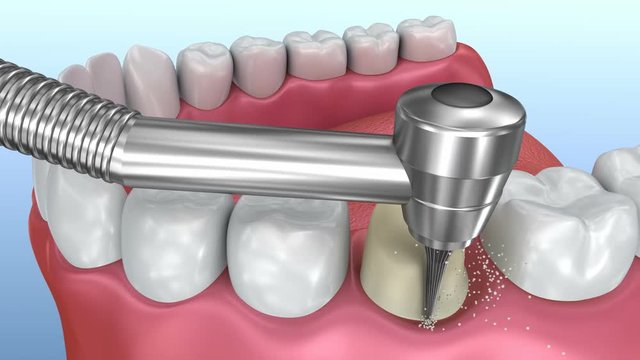 Dental crown installation process, Medically accurate 3d animation