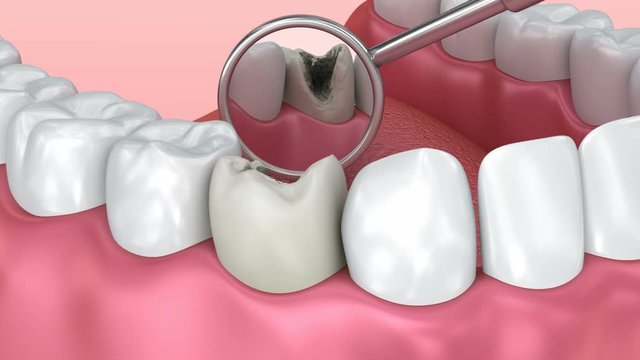 Teeth with caries inspection. Medically accurate tooth 3D animation.