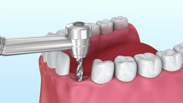 Tooth implant installation process, Medically accurate 3d animation