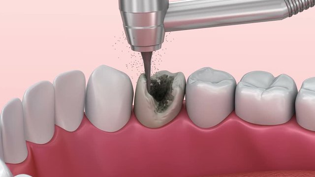Teeth with caries, treatment. Medically accurate tooth 3D animation.