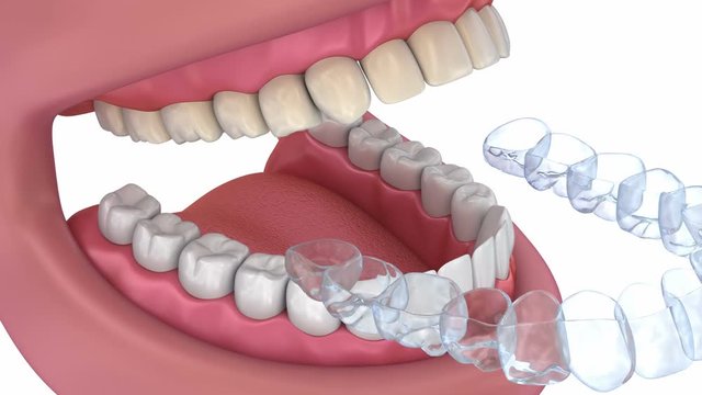 Teeth whitening process. Medically accurate tooth 3D animation.