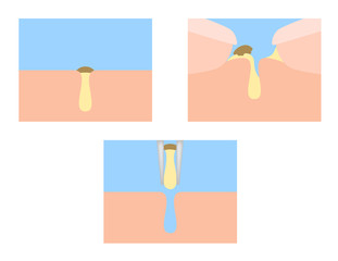 finger squeeze acne out vector