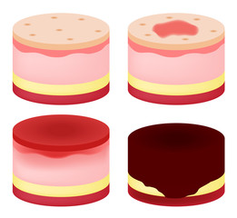 step of burn . Normal to serious burn skin . vector and icon