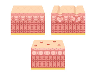 normal aging and acne skin vector