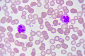 Neutrophil cell (white blood cell) in blood smear, analyze by microscope
