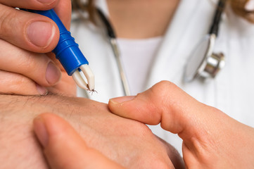 Doctor removing a tick with tweezers from hand of patient