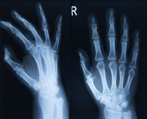 Röntgenbild der rechten Hand