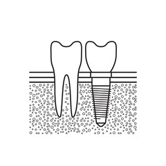Dental implant located adjacent to a healthy tooth in a patients mouth, vector illustration isolated on white background