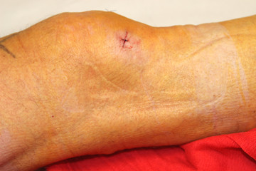 Knie nach Meniskusoperation