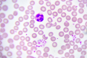 Neutrophil cell (white blood cell) in blood smear, analyze by microscope
