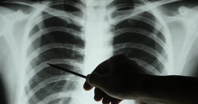 4k doctors study ribs,Rib-cage joints X-ray film for analysis.medical health hospital.