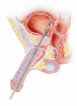 Penis with a resectoscope instrument inserted, cutaway cross section. Shown are the corpus cavemosum, prostate gland, testis, scrotum, anus, rectum, ureteral orifice, urinary bladder, and pubic bone.