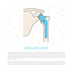 Shoulder prosthesis, vector banner with place for text. Medical illustration