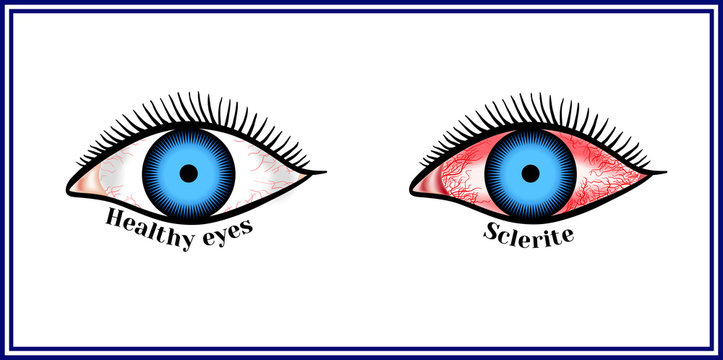 Sclerite. Inflammatory disease of sclera.